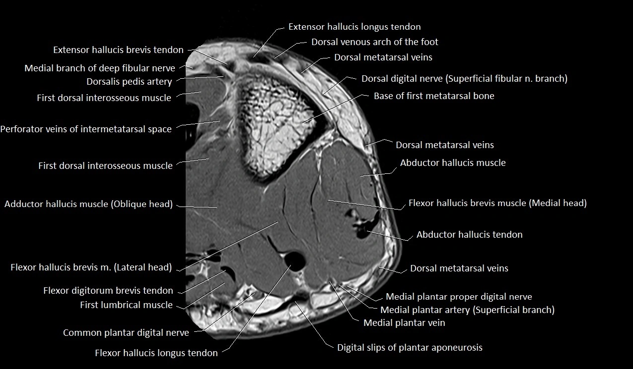Great toe (hallux) axial microanatomy 3T MRI image 40.webp